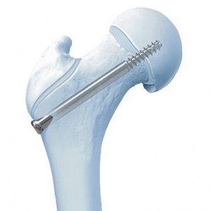 Tornillos